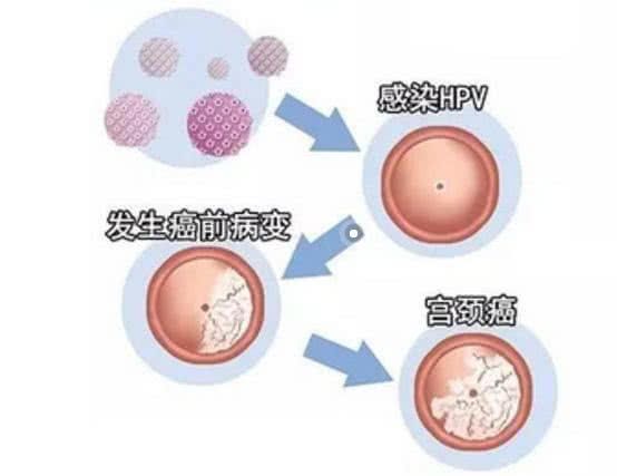 HPV病毒最新治疗方法，探索变化的力量，自信与成就感的源泉